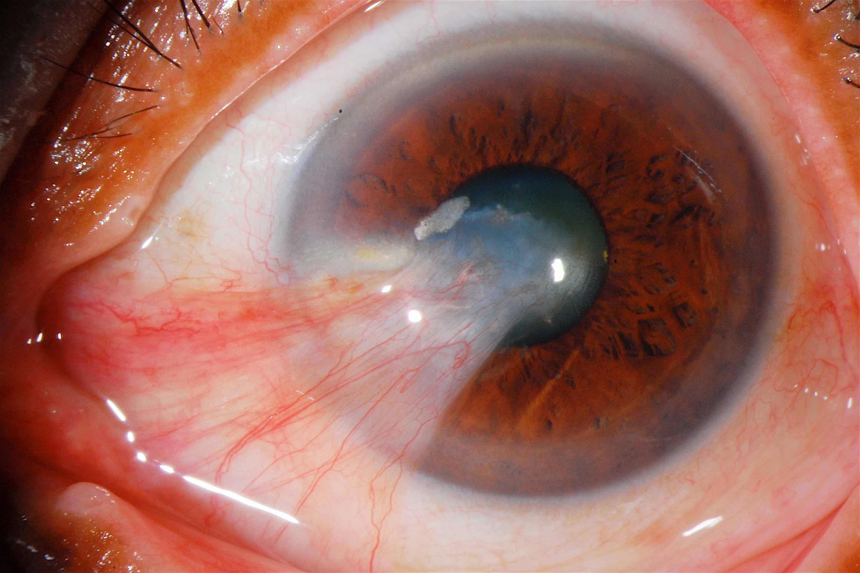 Pterygium