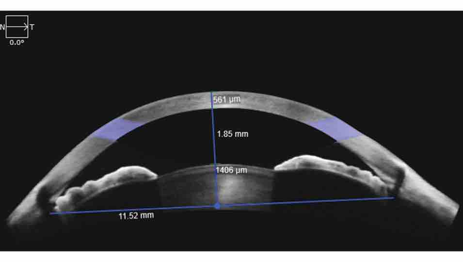 CirrusAnteriorSegment_web