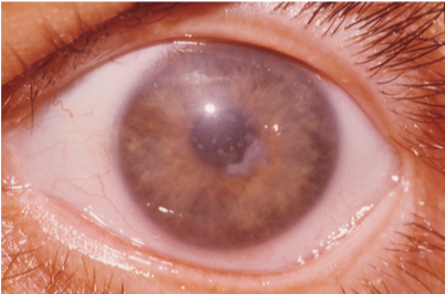 CornealDystrophy