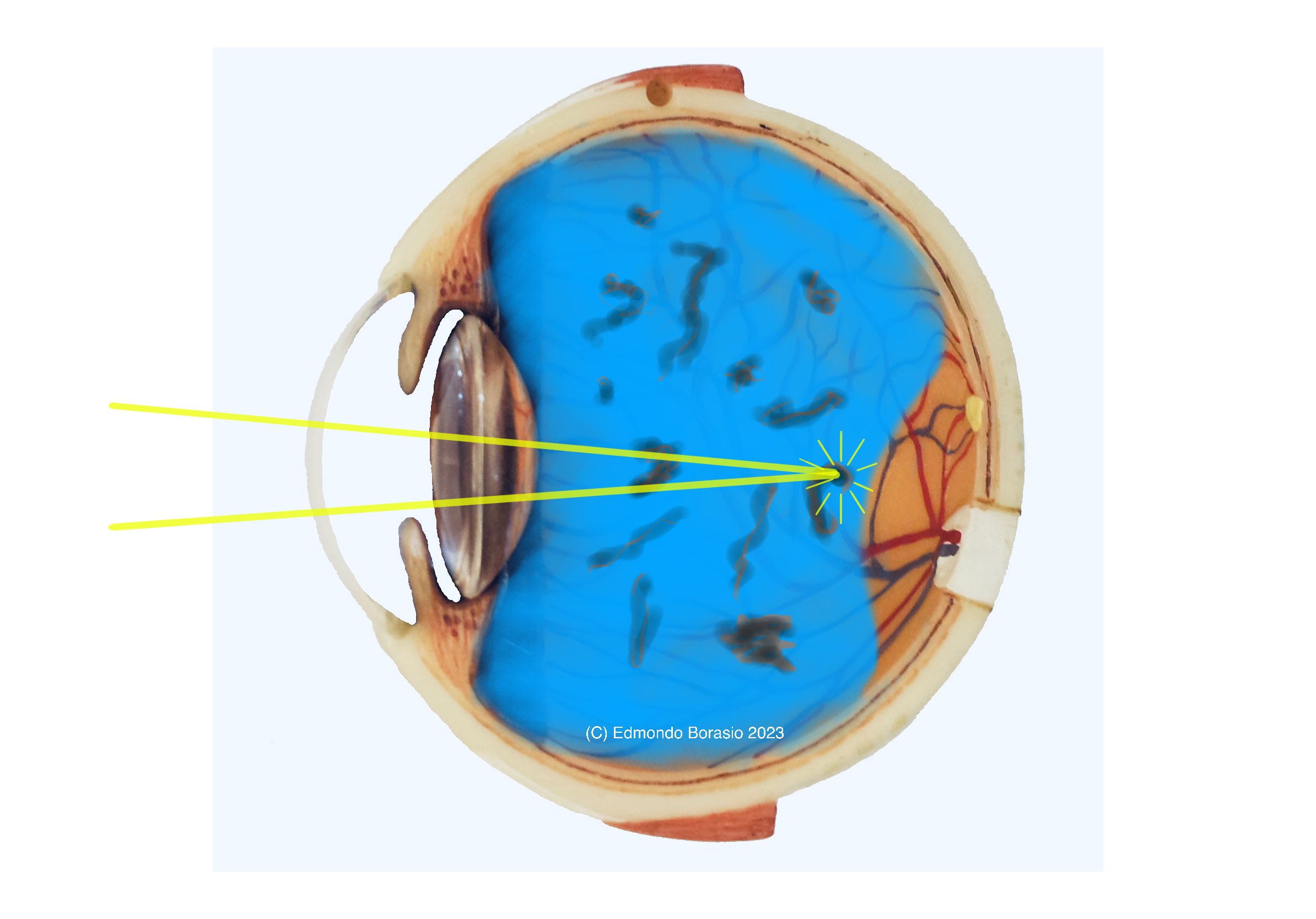 EBorasioDiagramPVDandFloatersYagLysisC