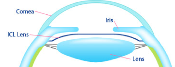 ICLposition