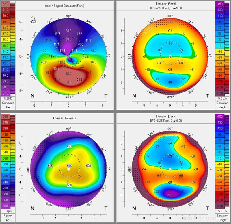 PentacamCornealTopographyKeratoconus