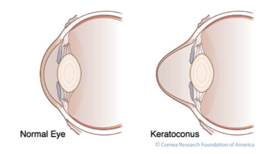 KeratoconusVNormalCornea