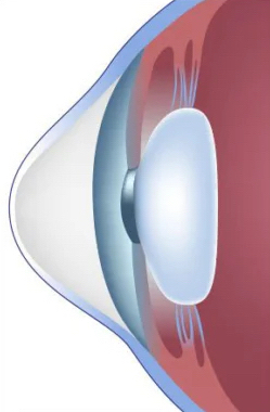 Keratoconus.jpeg