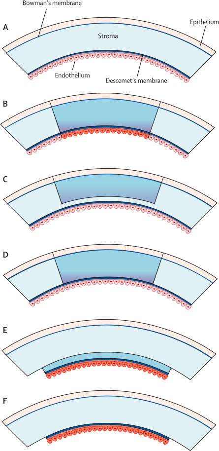 DiagramDifferentKeratoplastyTypes