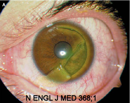 lasik flap-dislodged-by-screwdriver%28NEJM%29